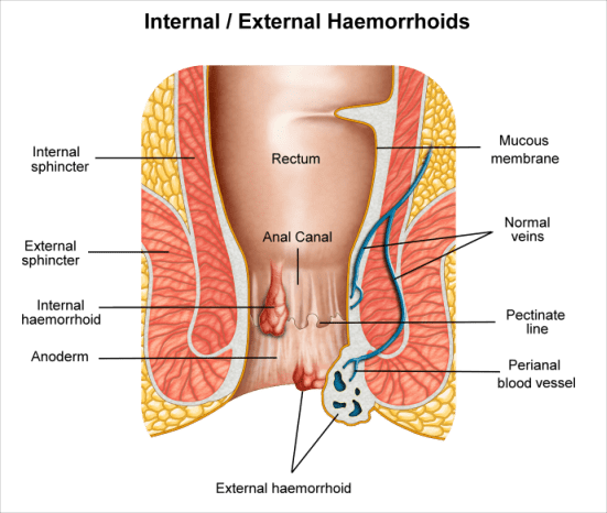 Treatment for external & internal hemorrhoids with our anal fissure cream